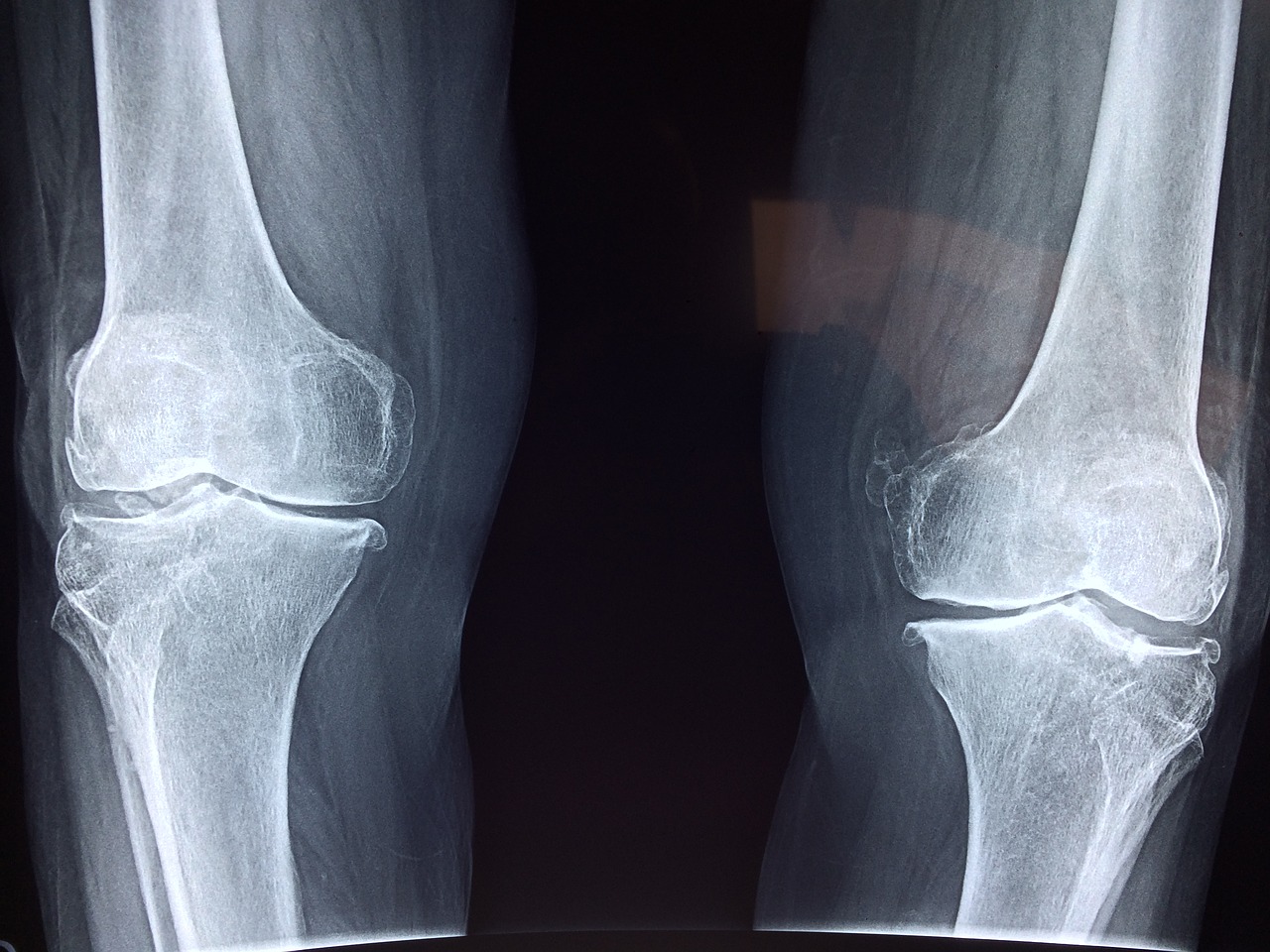 radiografía huesos piernas