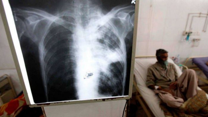 radiografia tuberculosis persona
