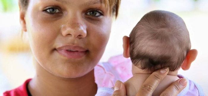 Madre y bebé con microcefalia por zika. (OMS)
