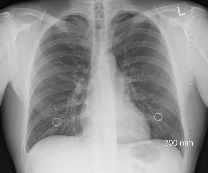 radiografía de pulmones