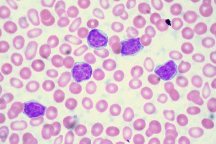leucemia